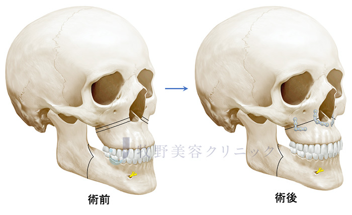 下顎骨を削る手術(術前、術後)