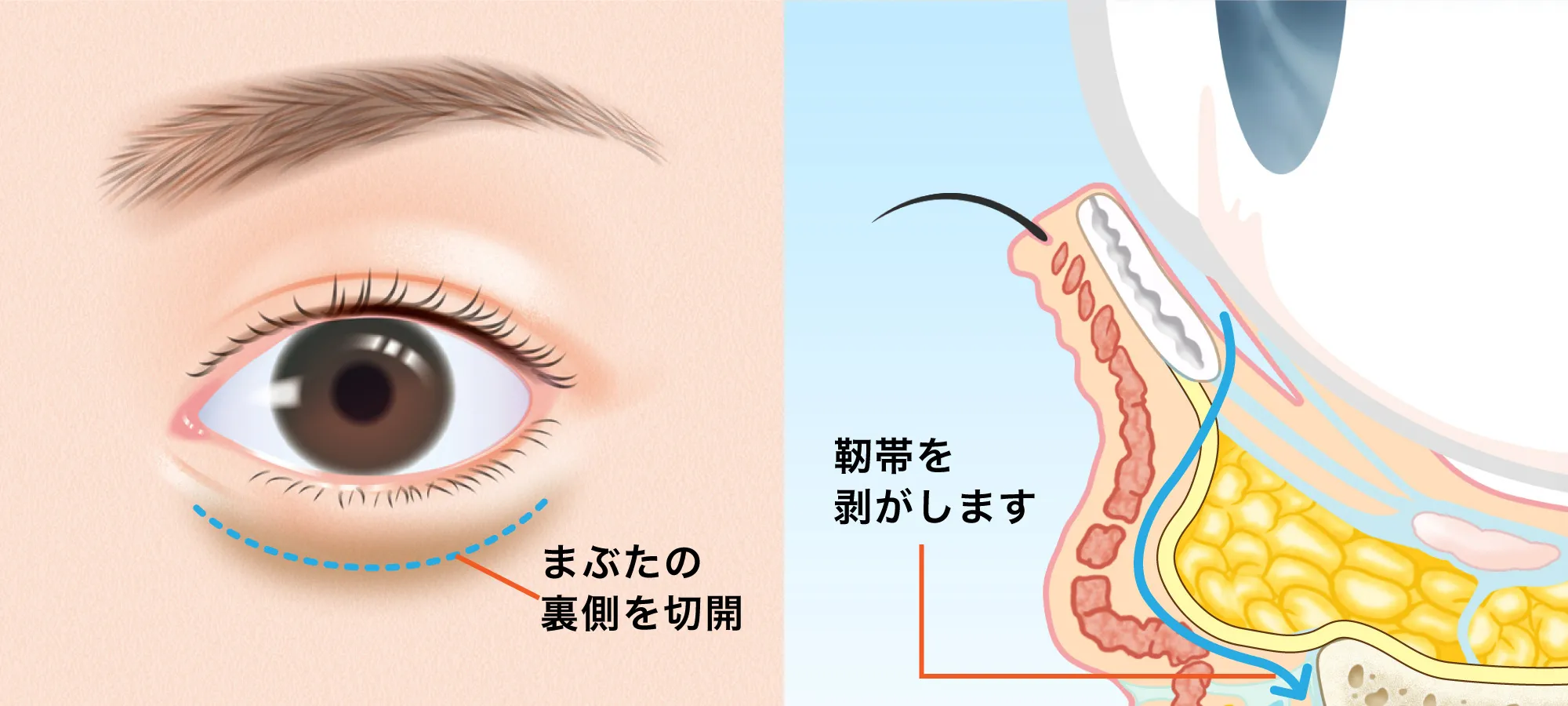 下まぶたの裏側を切開