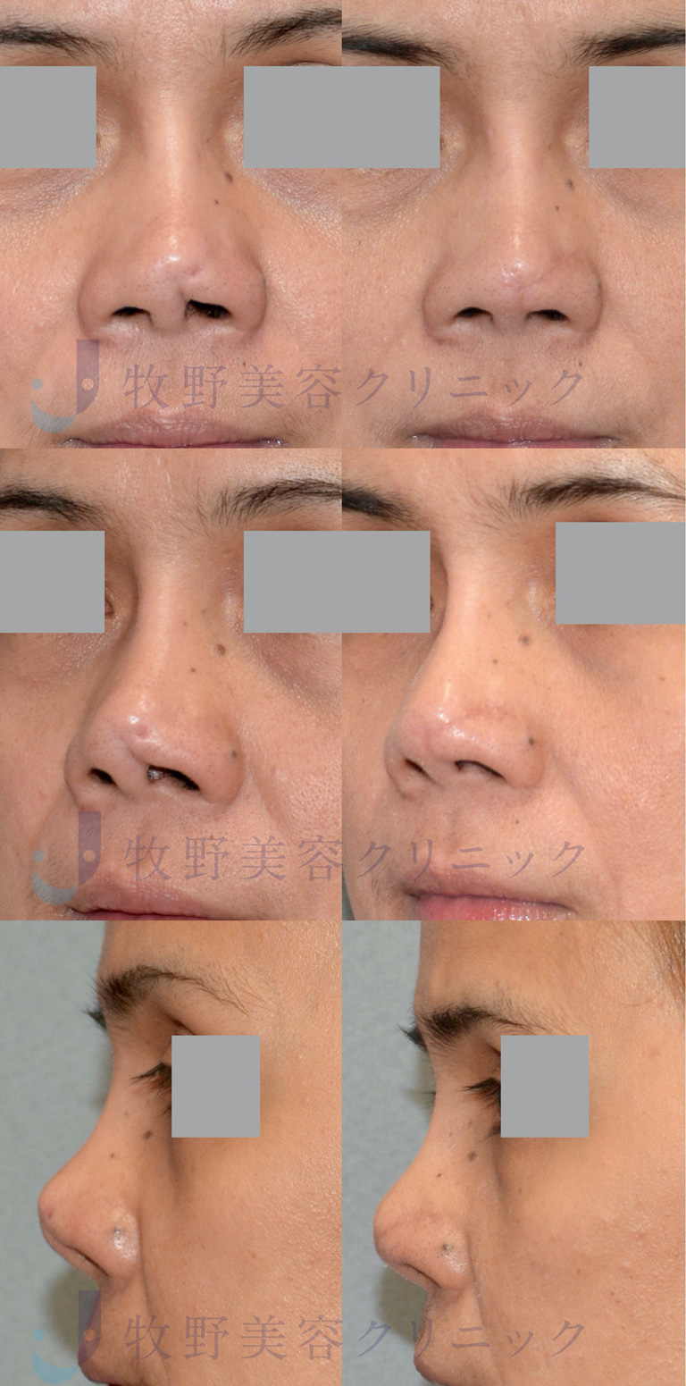 鼻の瘢痕修正（美容外科後遺症）