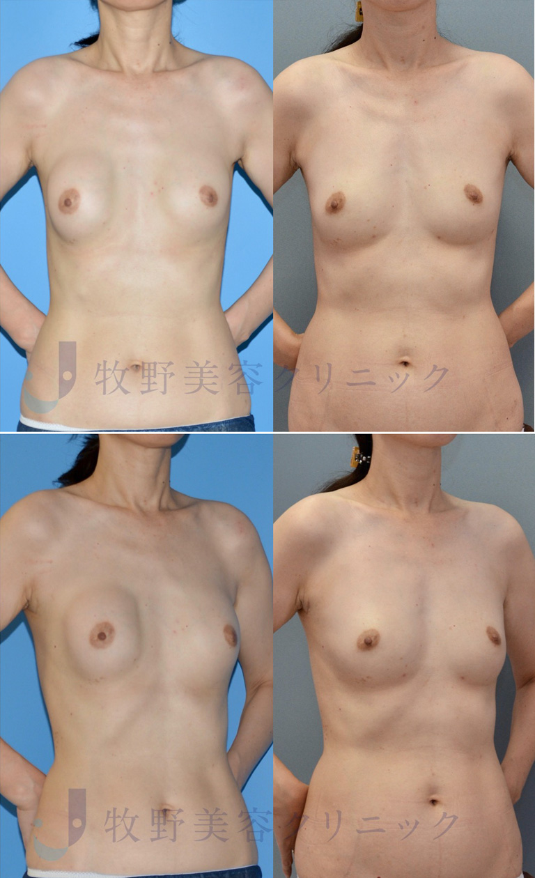 乳房増大シリコンインプラント除去、脂肪注入乳房増大術（ピュアグラフト使用）